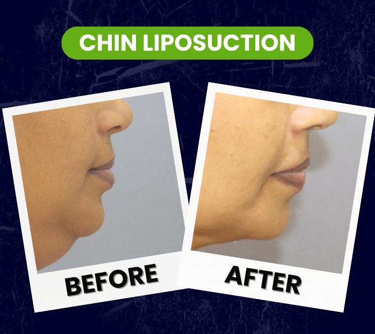 chin liposuction plastic surgery